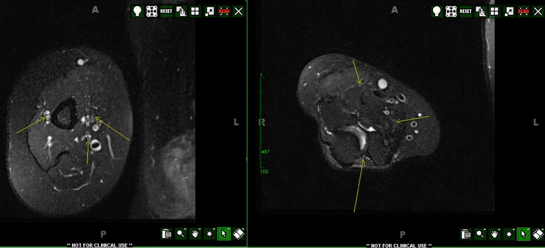 Figure 5 for case Multifocal motor neuropathy